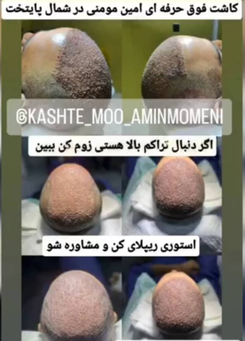 کاشت مو و ابرو امین مومنی در جنت آباد تهران