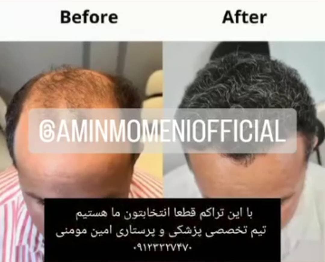 کاشت مو و ابرو امین مومنی در جنت آباد تهران