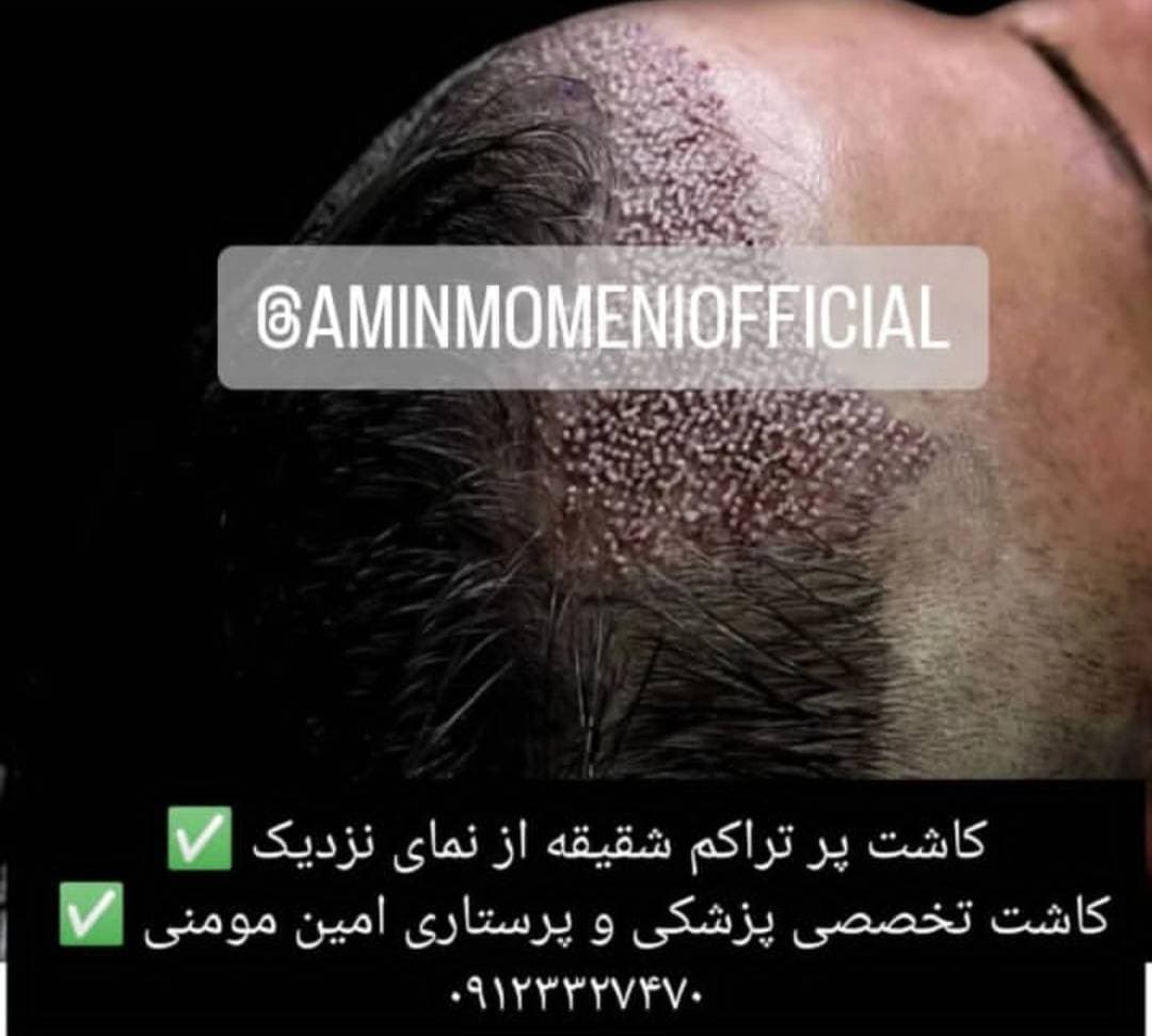کاشت مو و ابرو امین مومنی در جنت آباد تهران