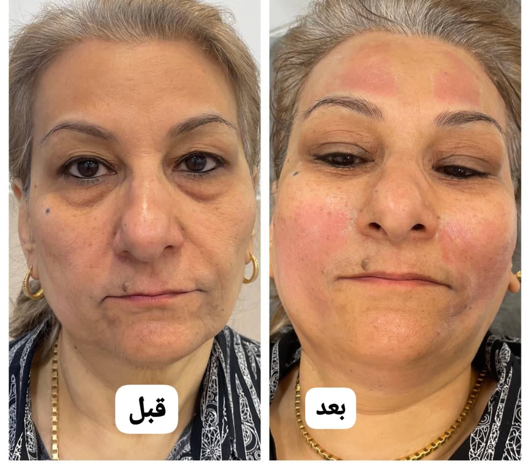 خدمات تخصصی لیزر موهای زائد رویا درخشان در اصفهان