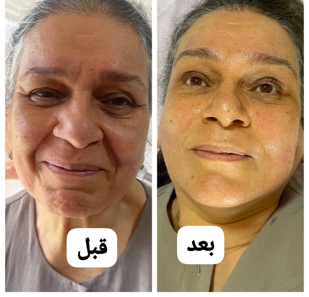 خدمات تخصصی لیزر موهای زائد رویا درخشان در اصفهان