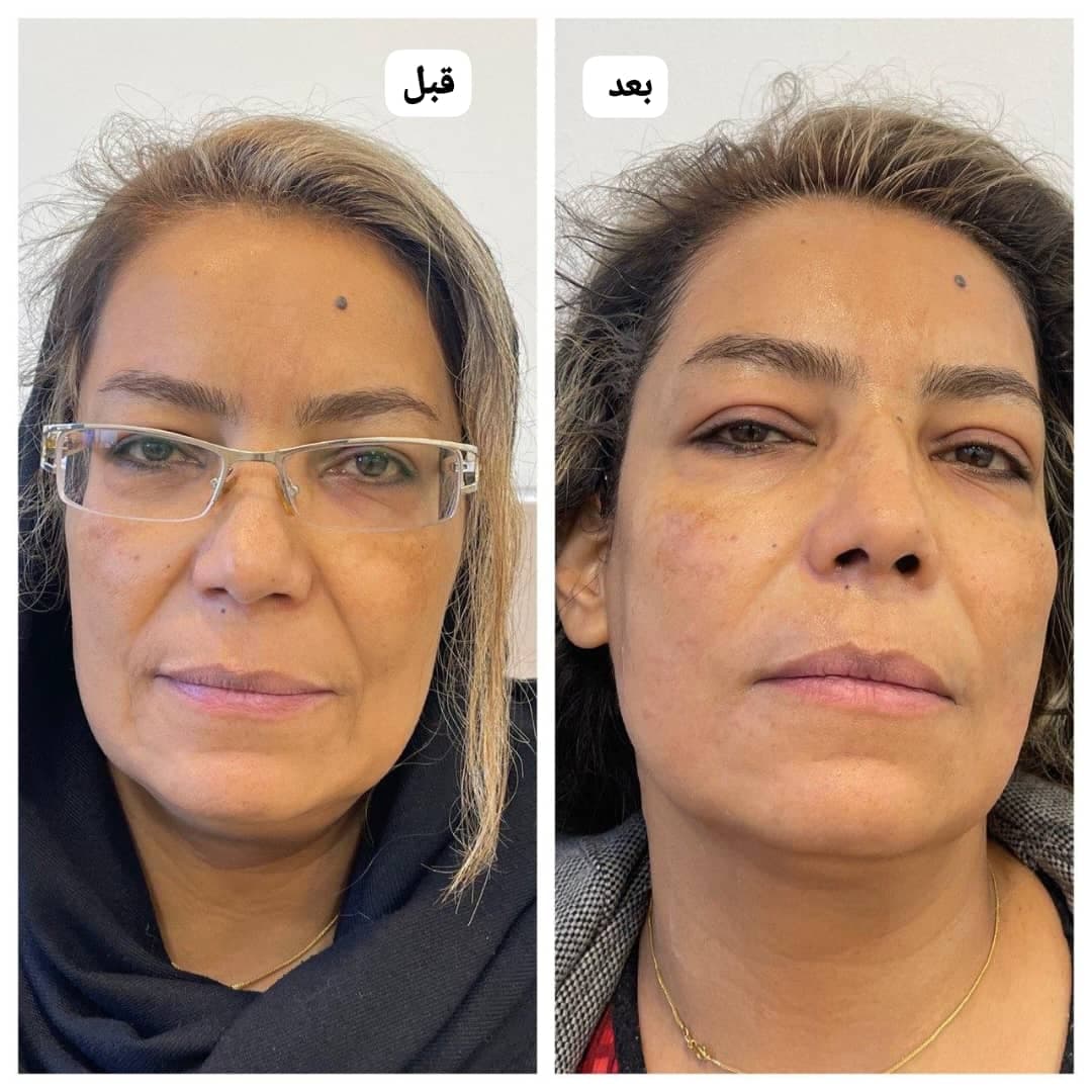 خدمات تخصصی لیزر موهای زائد رویا درخشان در اصفهان