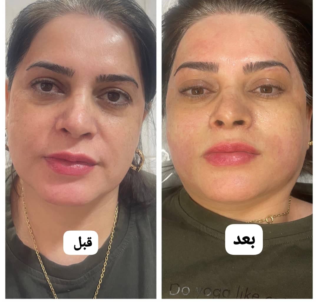 خدمات تخصصی لیزر موهای زائد رویا درخشان در اصفهان