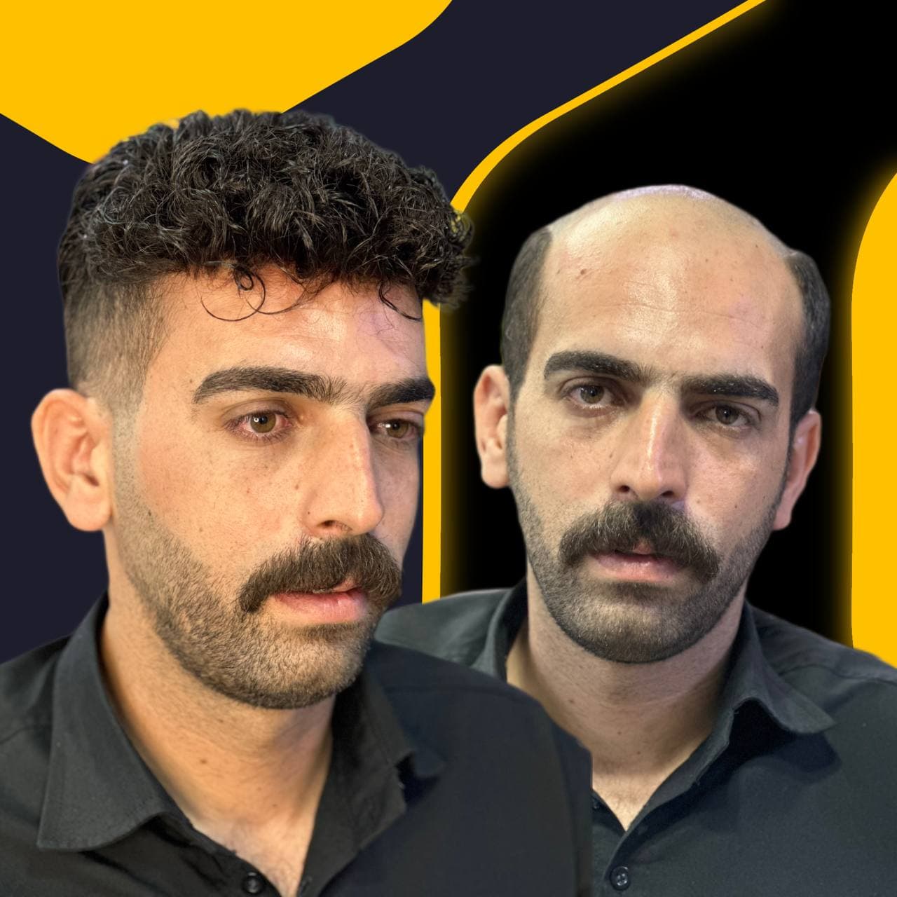 مرکز تخصصی پروتز مو ایران مو در اصفهان