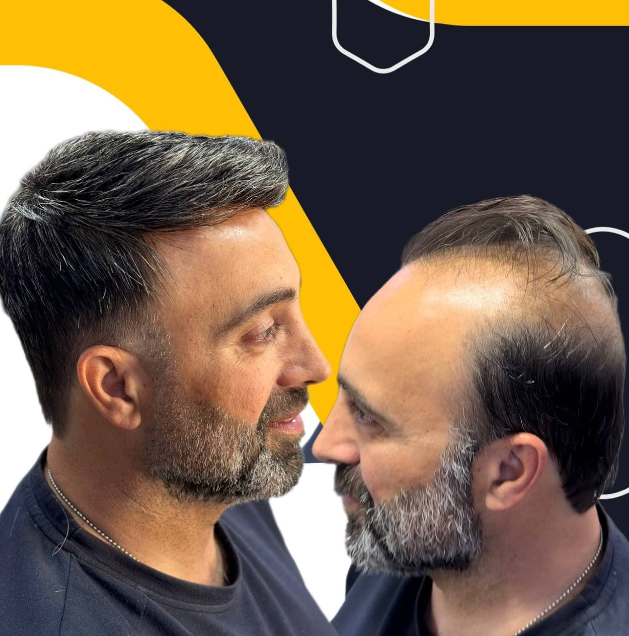 مرکز تخصصی پروتز مو ایران مو در اصفهان