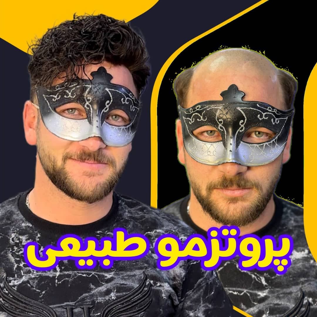 مرکز تخصصی پروتز مو ایران مو در اصفهان