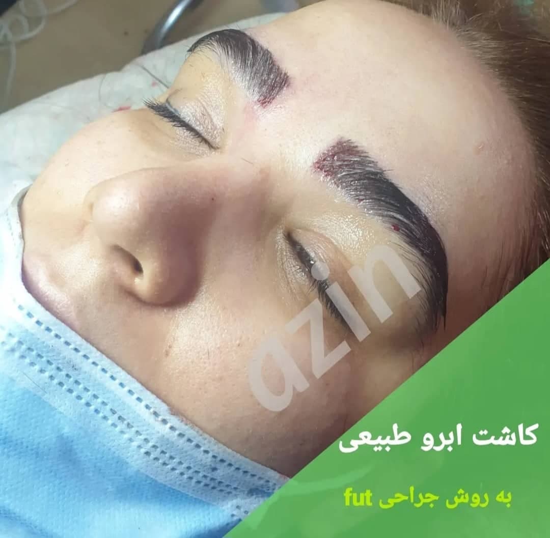 کلینیک کاشت مو و ابرو آذین در سنندج
