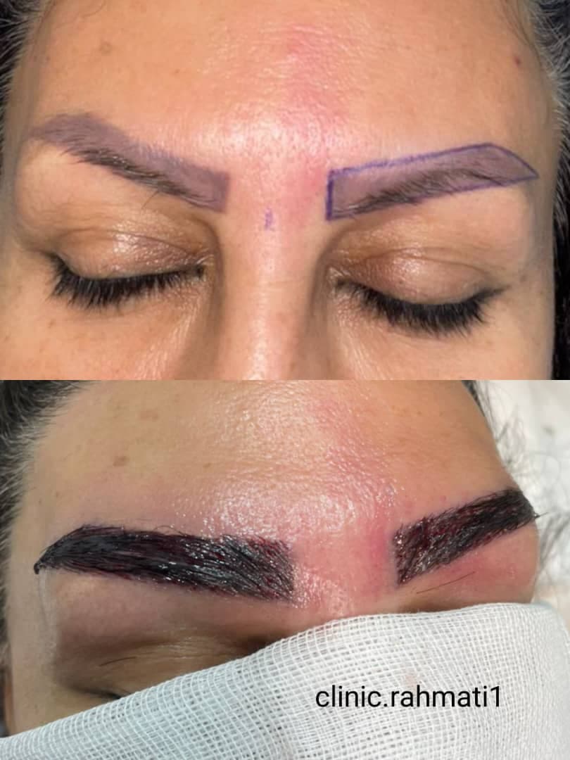 کلینیک تخصصی کاشت مو و ابرو رحمتی در ملارد