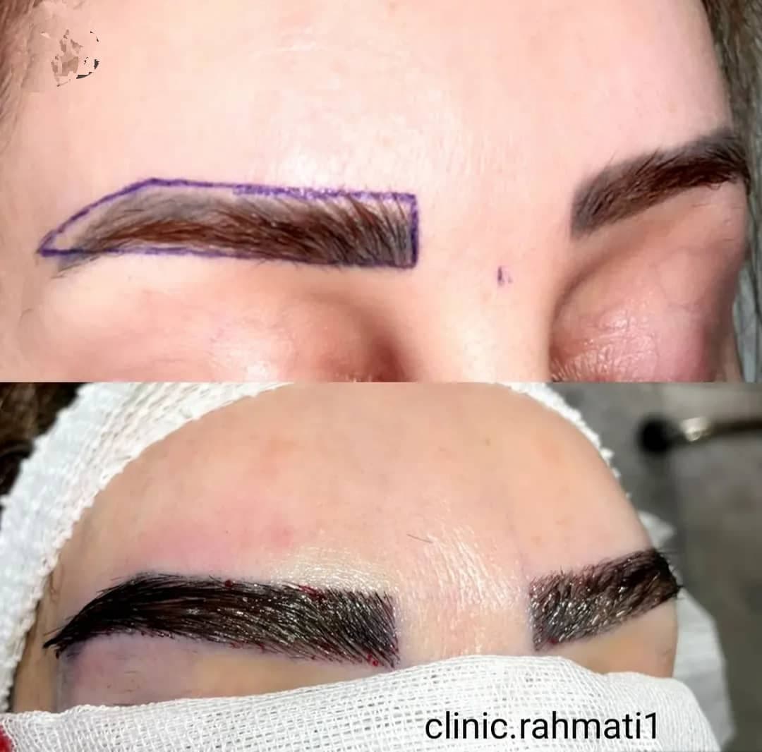کلینیک تخصصی کاشت مو و ابرو رحمتی در ملارد