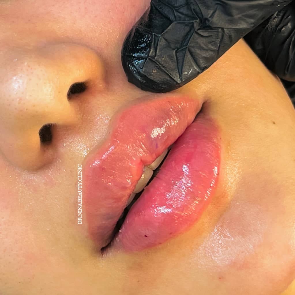 مرکز تخصصی فیلر لب نینا در قائمشهر