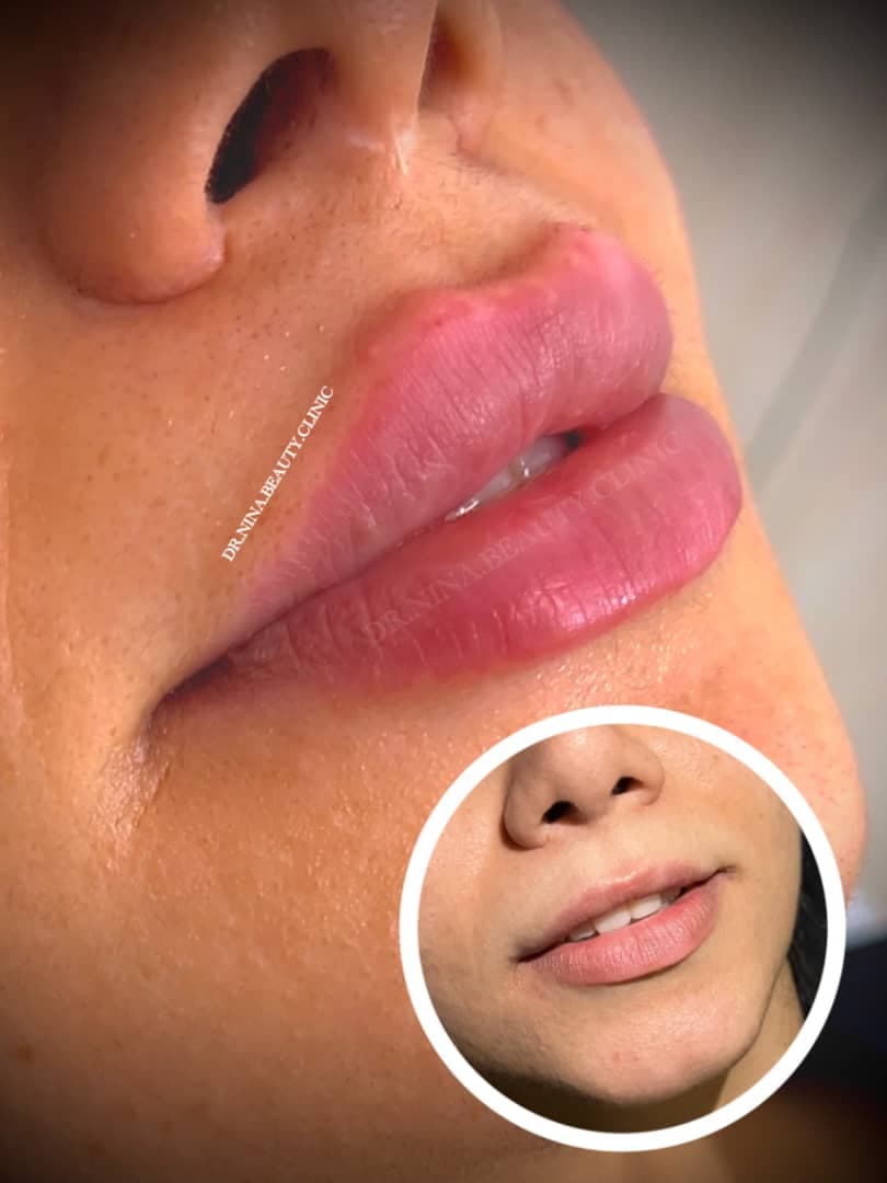 مرکز تخصصی فیلر لب نینا در قائمشهر