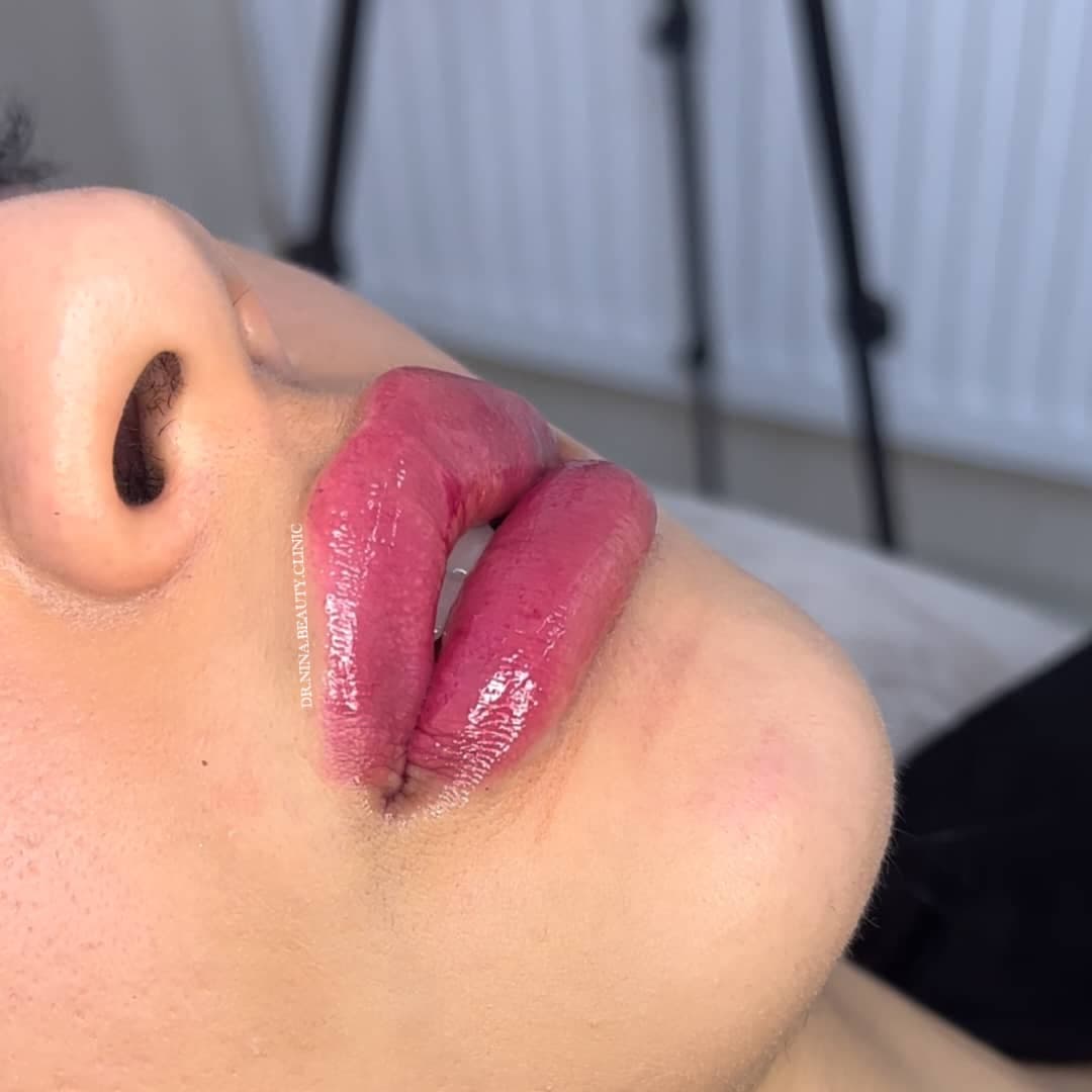 مرکز تخصصی فیلر لب نینا در قائمشهر