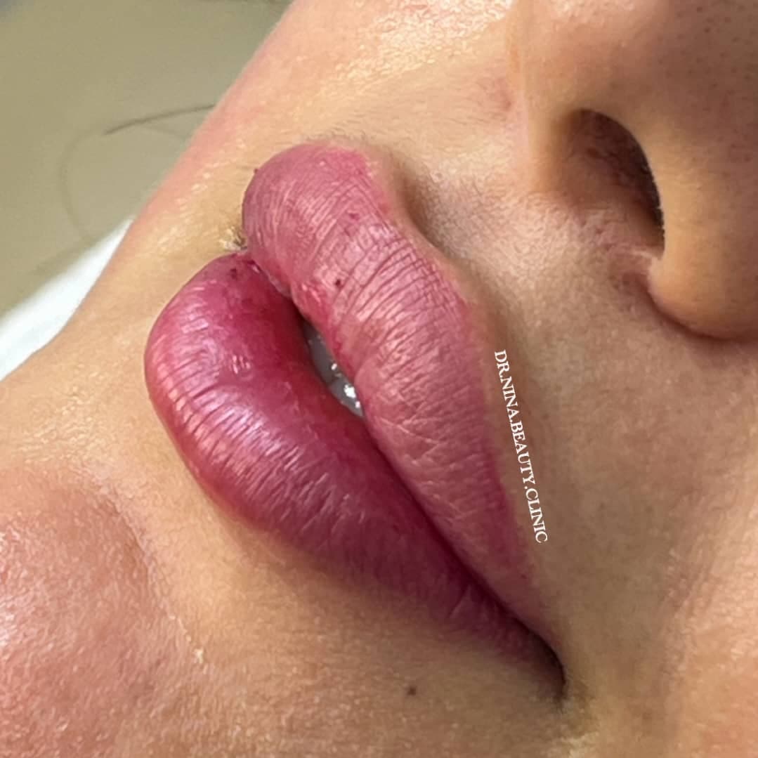 مرکز تخصصی فیلر لب نینا در قائمشهر