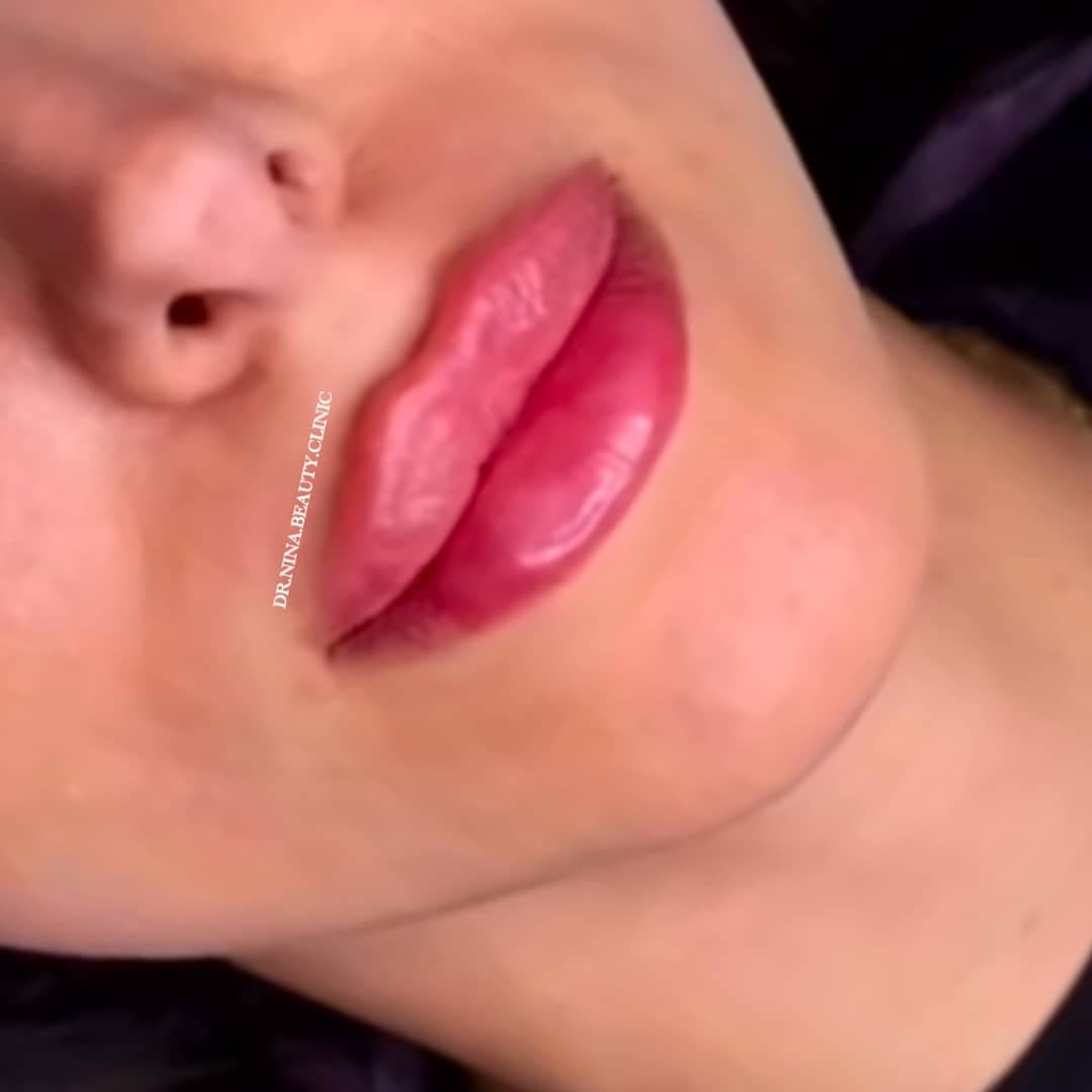 مرکز تخصصی فیلر لب نینا در قائمشهر