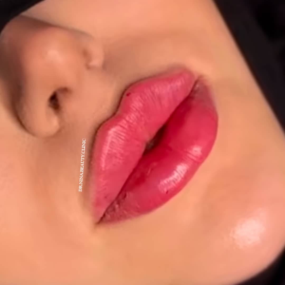 مرکز تخصصی فیلر لب نینا در قائمشهر