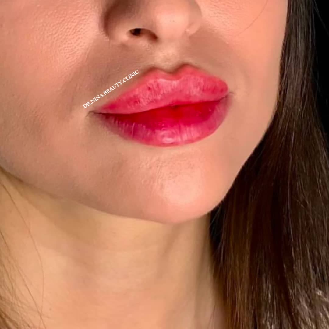 مرکز تخصصی فیلر لب نینا در قائمشهر