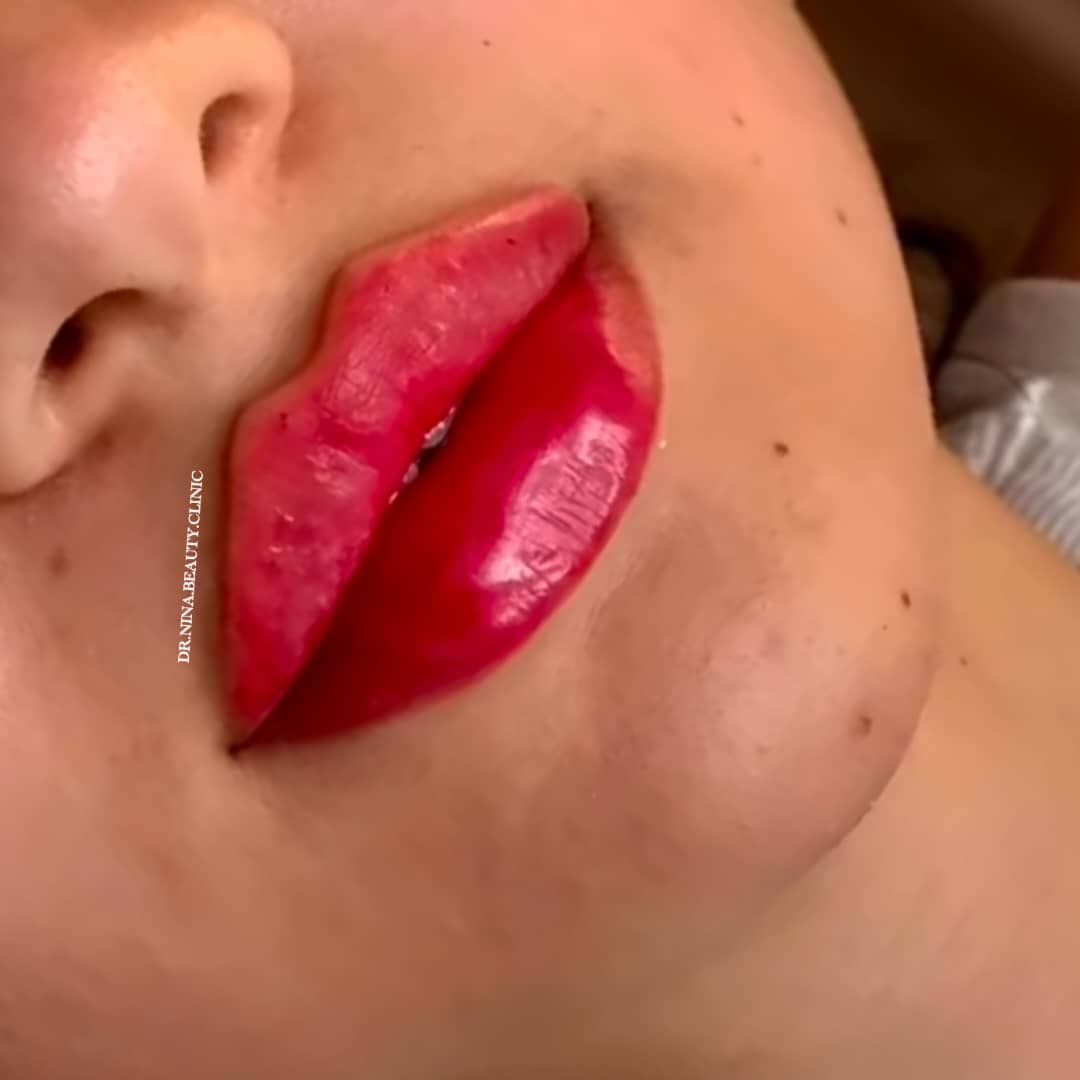 مرکز تخصصی فیلر لب نینا در قائمشهر