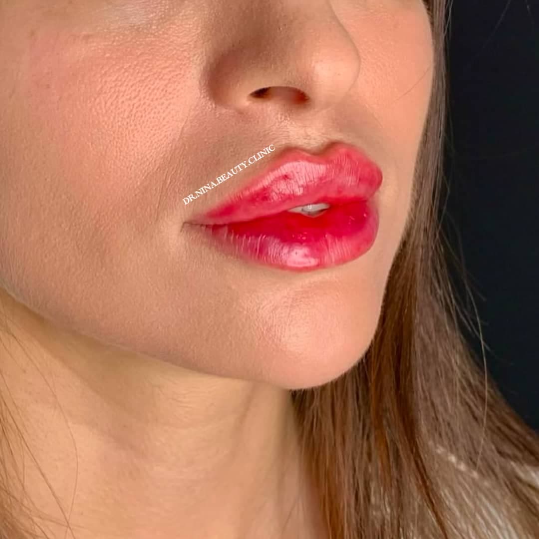 مرکز تخصصی فیلر لب نینا در قائمشهر