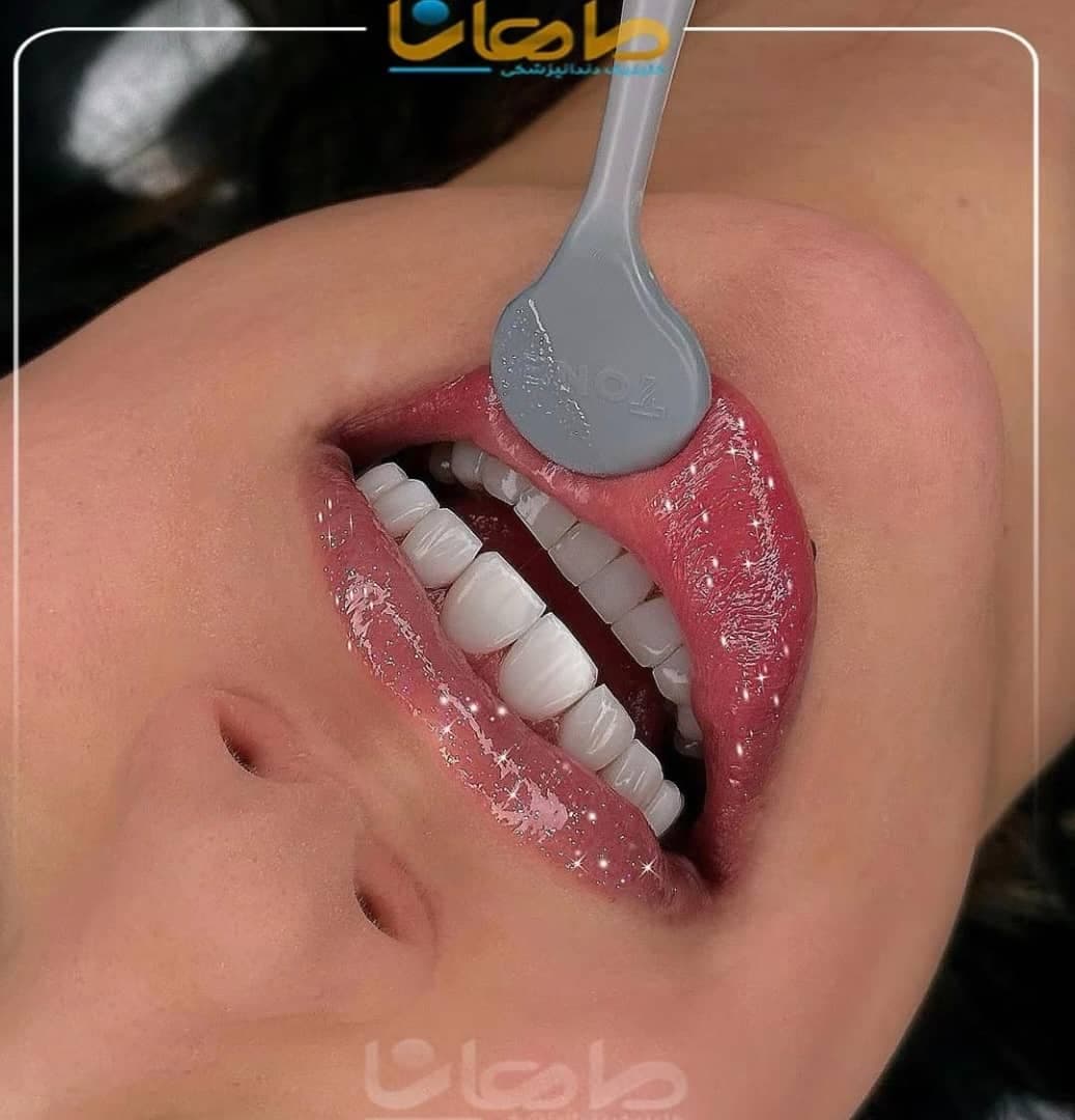 کلینیک تخصصی کامپوزیت و ایمپلنت دندان ماهانا در مطهری کرج