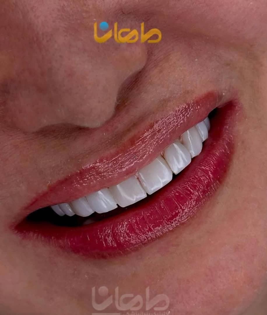 کلینیک تخصصی کامپوزیت و ایمپلنت دندان ماهانا در مطهری کرج