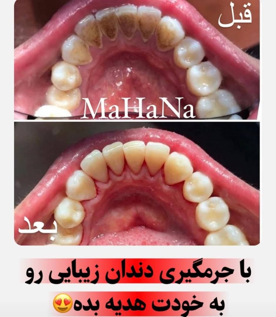 کلینیک تخصصی کامپوزیت و ایمپلنت دندان ماهانا در مطهری کرج