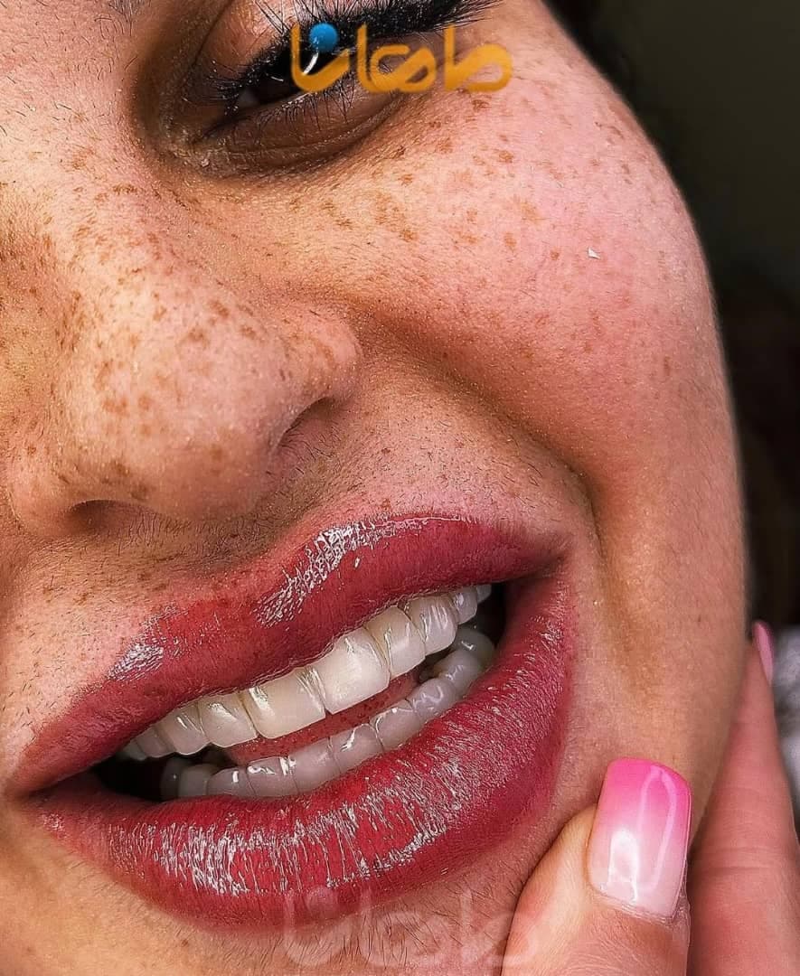 کلینیک تخصصی کامپوزیت و ایمپلنت دندان ماهانا در مطهری کرج