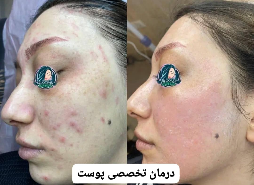 آموزش و خدمات درمان تخصصی پوست نیلوفر کریمی در اردبیل