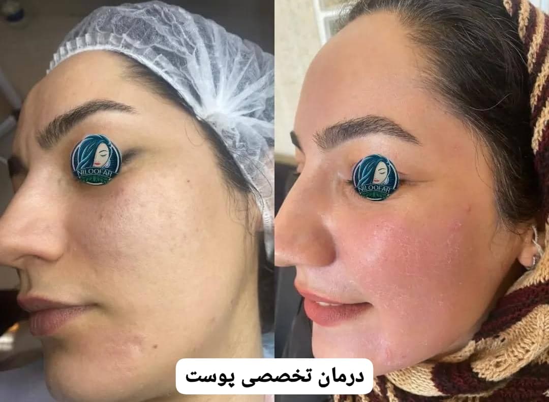 آموزش و خدمات درمان تخصصی پوست نیلوفر کریمی در اردبیل