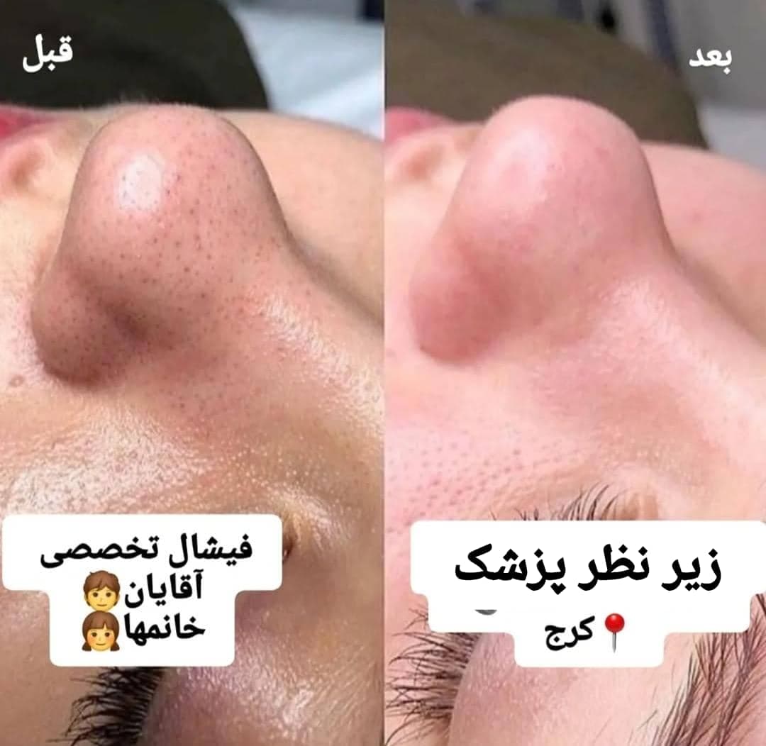 آموزش خدمات تخصصی پاکسازی پوست و فیشال صورت زهرا دودانگه در کرج
