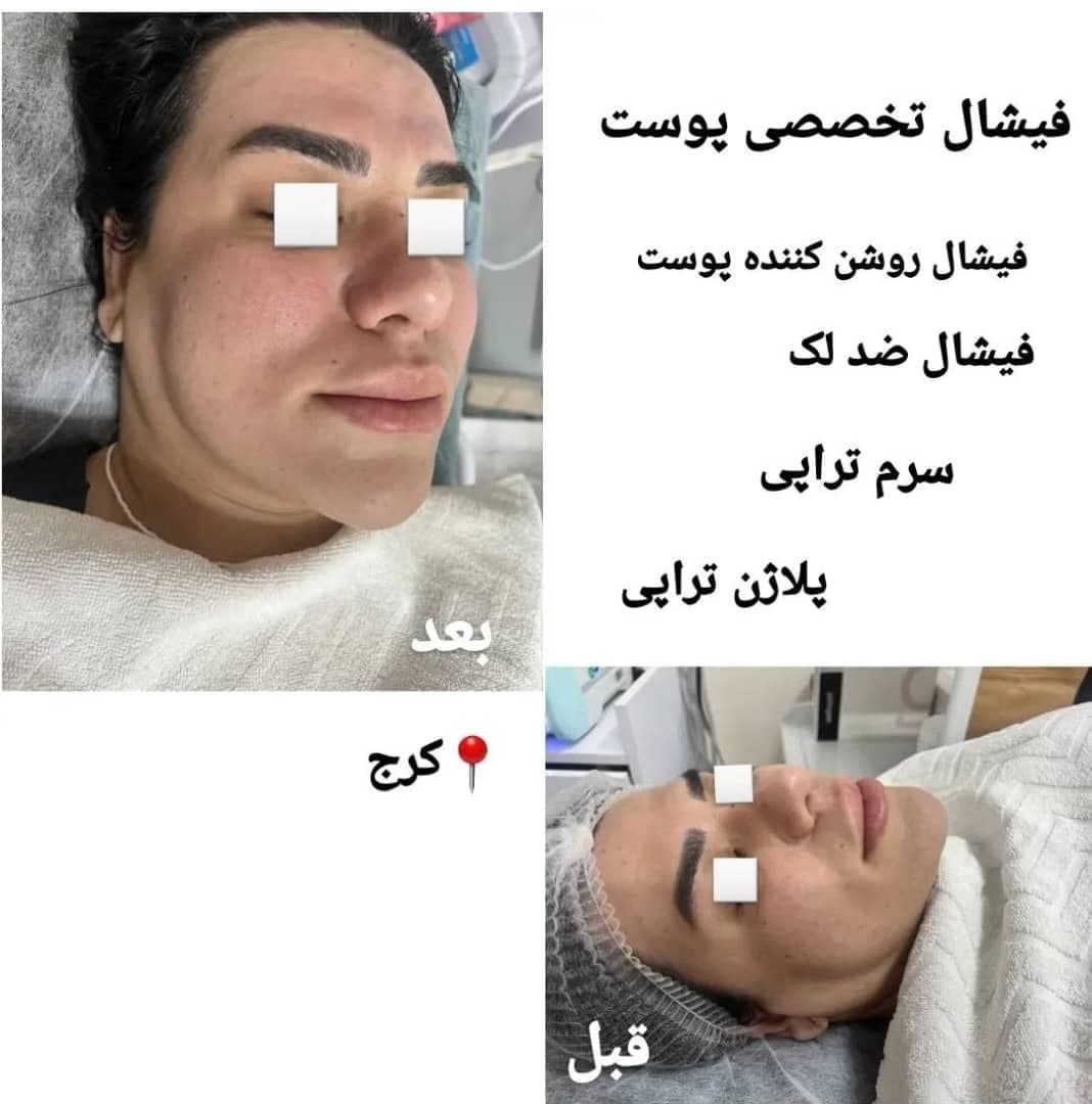 آموزش خدمات تخصصی پاکسازی پوست و فیشال صورت زهرا دودانگه در کرج