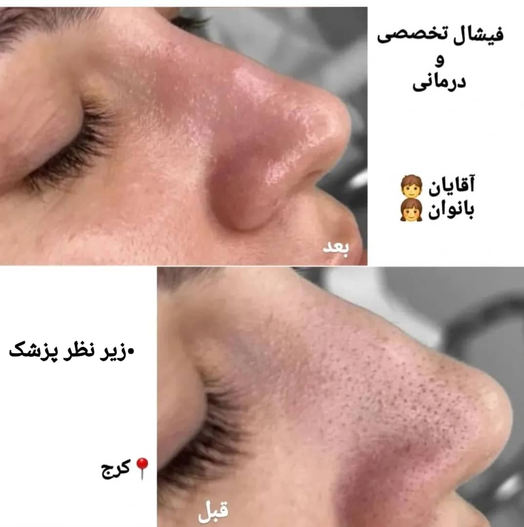 آموزش خدمات تخصصی پاکسازی پوست و فیشال صورت زهرا دودانگه در کرج