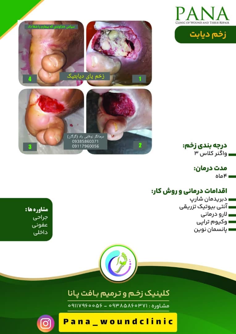 کلینیک زخم و ترمیم بافت پانا در گرگان