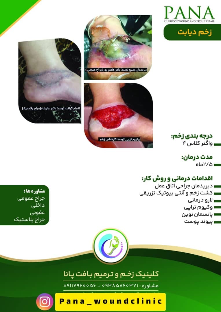 کلینیک زخم و ترمیم بافت پانا در گرگان
