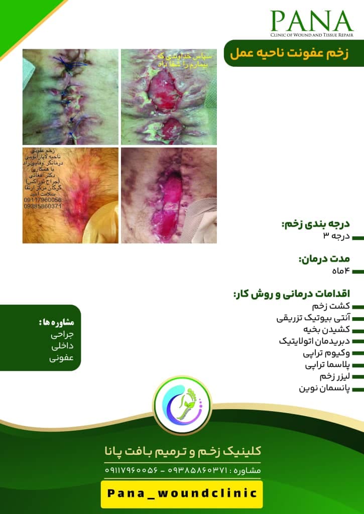 کلینیک زخم و ترمیم بافت پانا در گرگان
