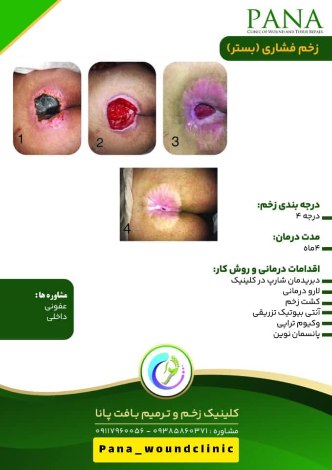 کلینیک زخم و ترمیم بافت پانا در گرگان