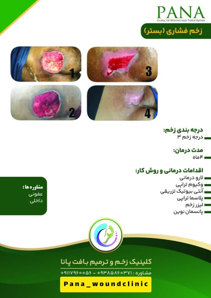 کلینیک زخم و ترمیم بافت پانا در گرگان