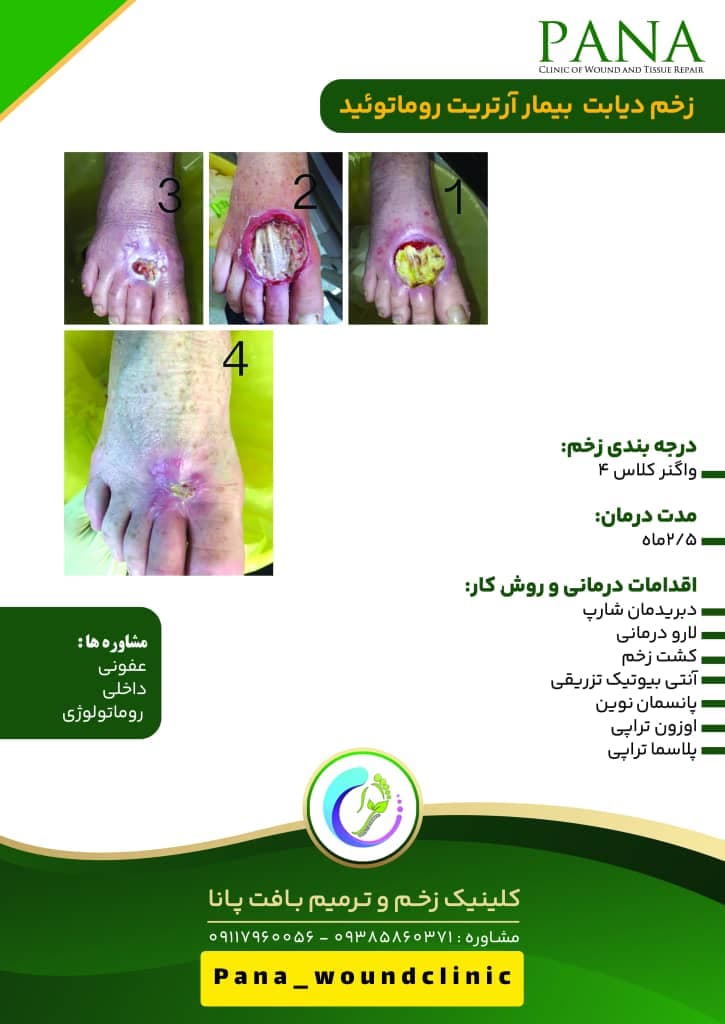 کلینیک زخم و ترمیم بافت پانا در گرگان