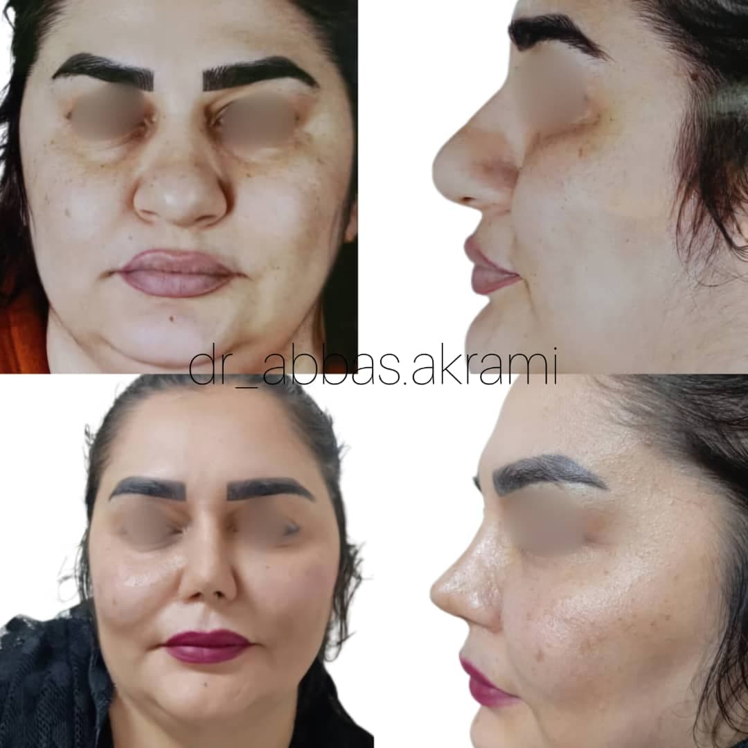 فوق تخصص جراحی پلاستیک زیبایی و ترمیمی دکتر عباس اکرمی در شیراز
