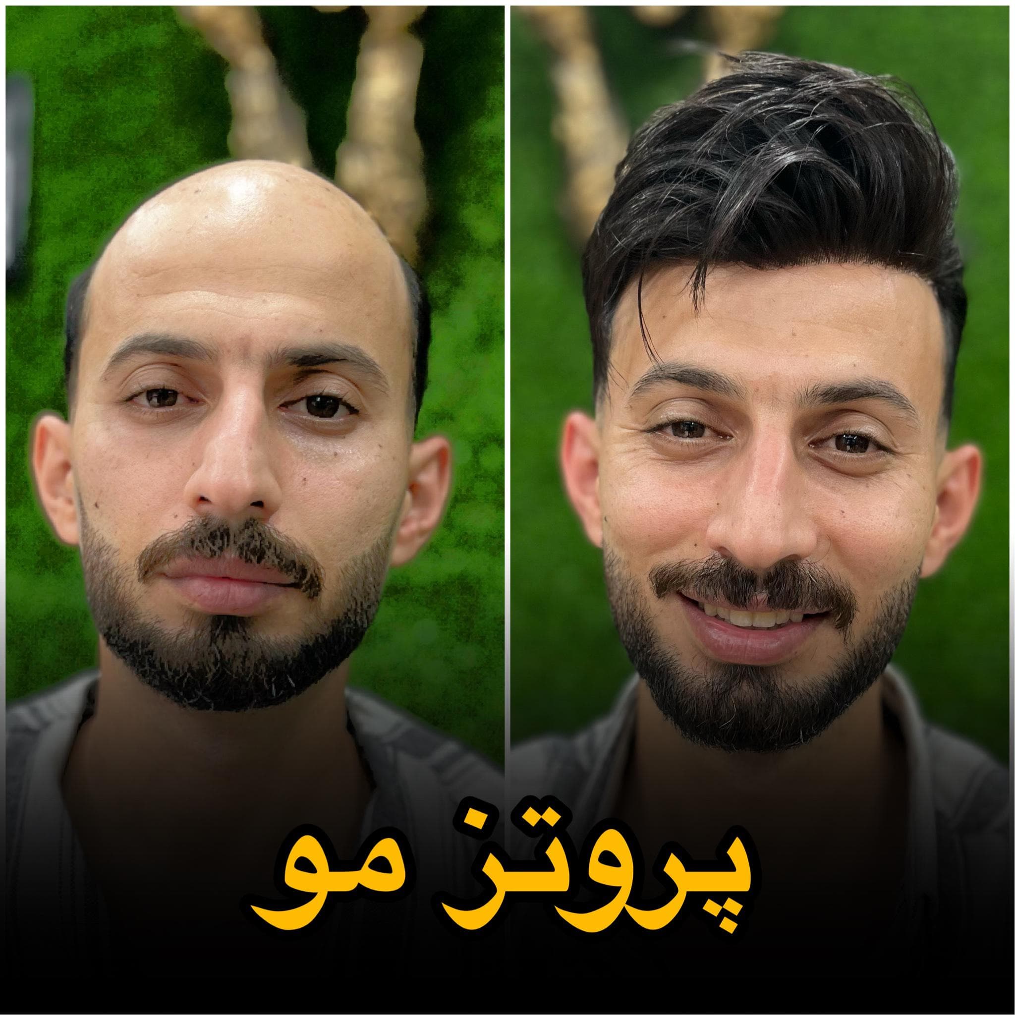 مرکز تخصصی vip پروتز مو علیرام استایل در شهید بهشتی لاهیجان