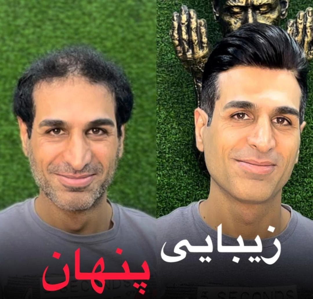 مرکز تخصصی vip پروتز مو علیرام استایل در شهید بهشتی لاهیجان