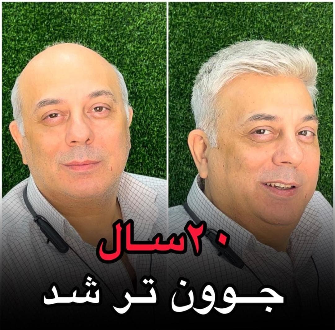 مرکز تخصصی vip پروتز مو علیرام استایل در شهید بهشتی لاهیجان