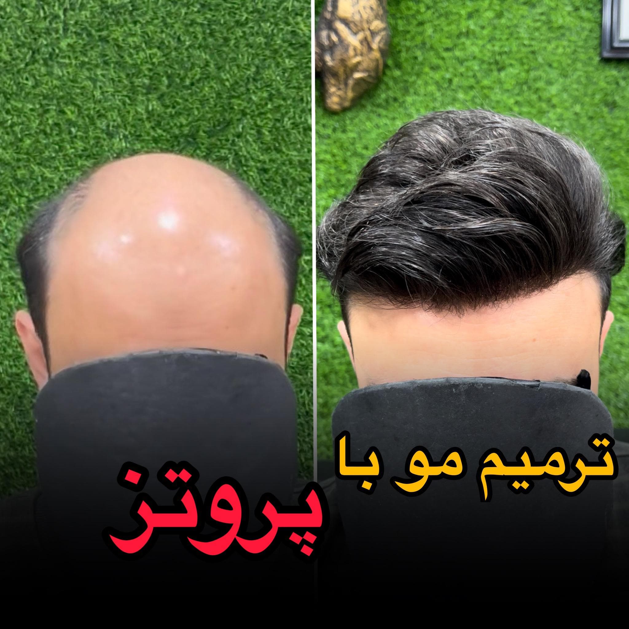 مرکز تخصصی vip پروتز مو علیرام استایل در شهید بهشتی لاهیجان