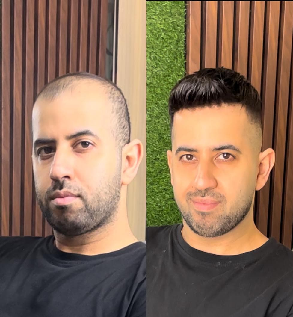 مرکز تخصصی vip پروتز مو علیرام استایل در شهید بهشتی لاهیجان