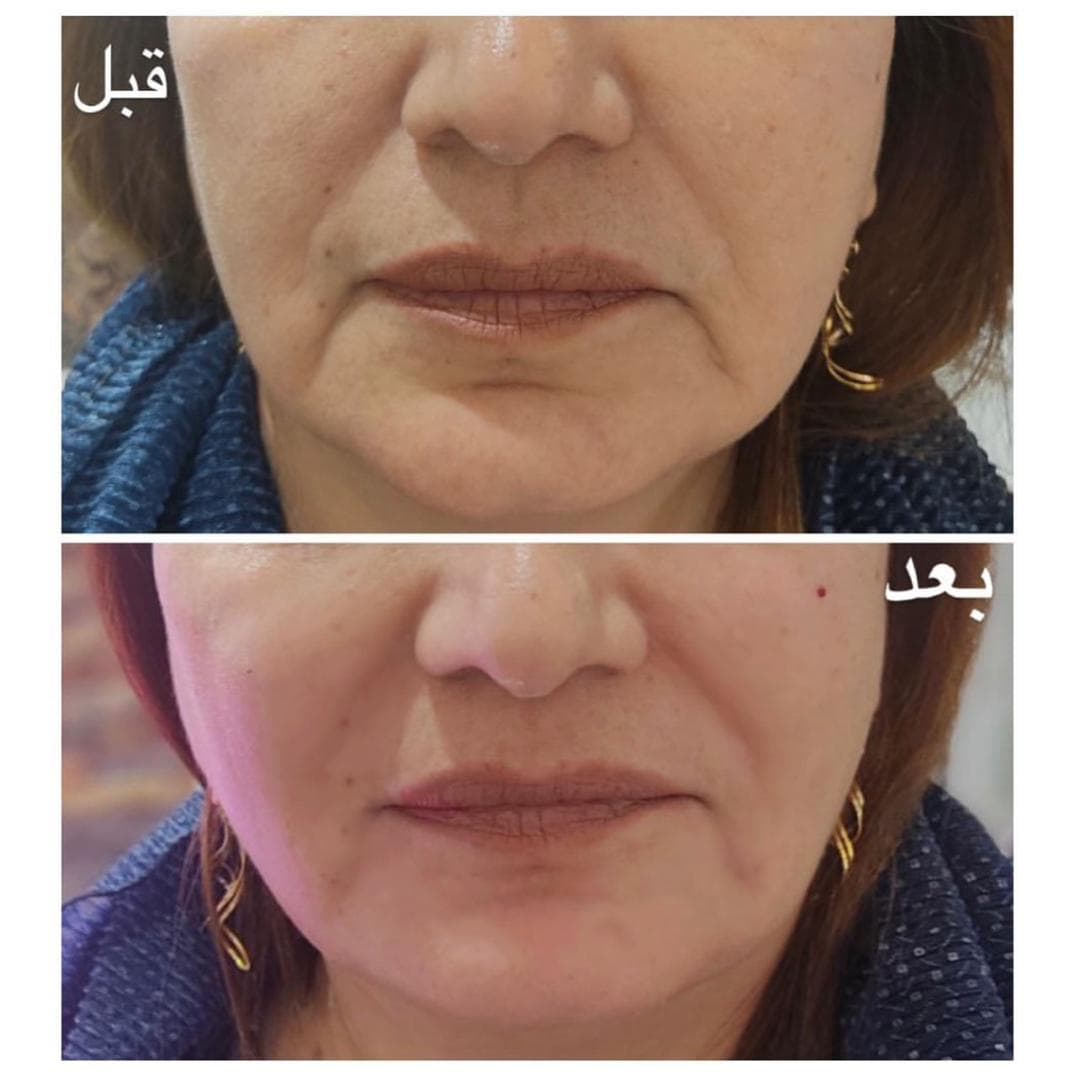 آموزش فیلر و بوتاکس آکادمی دکتر سهرابی در نوبهار کرمانشاه