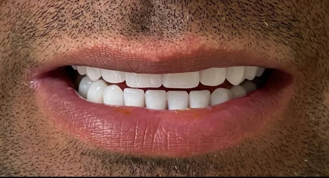 ساخت پروتز دندان مصنوعی طرح لمینت دکتر رضایی در یزد