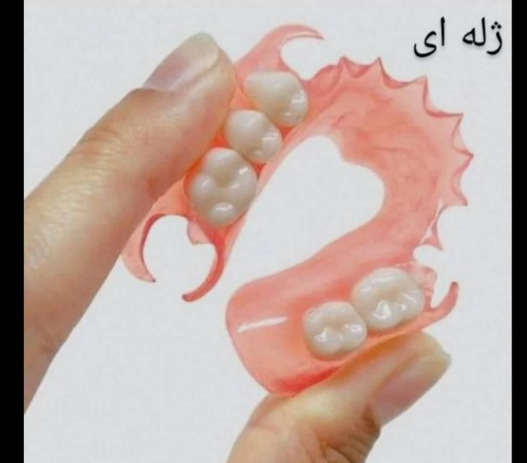 ساخت پروتز دندان مصنوعی طرح لمینت دکتر رضایی در یزد