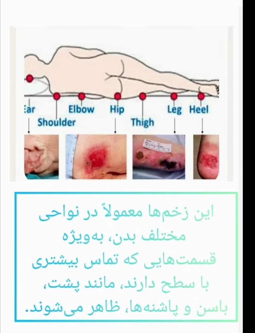 تزریقات و درمان زخم بستر آرامش در تنکابن