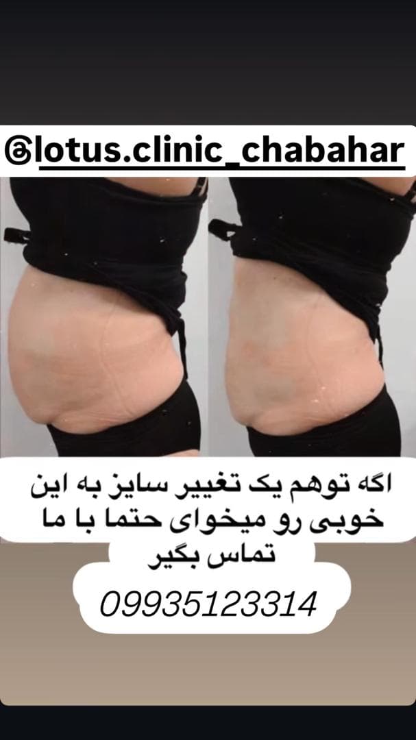 کلینیک زیبایی لاغری لوتوس در چابهار