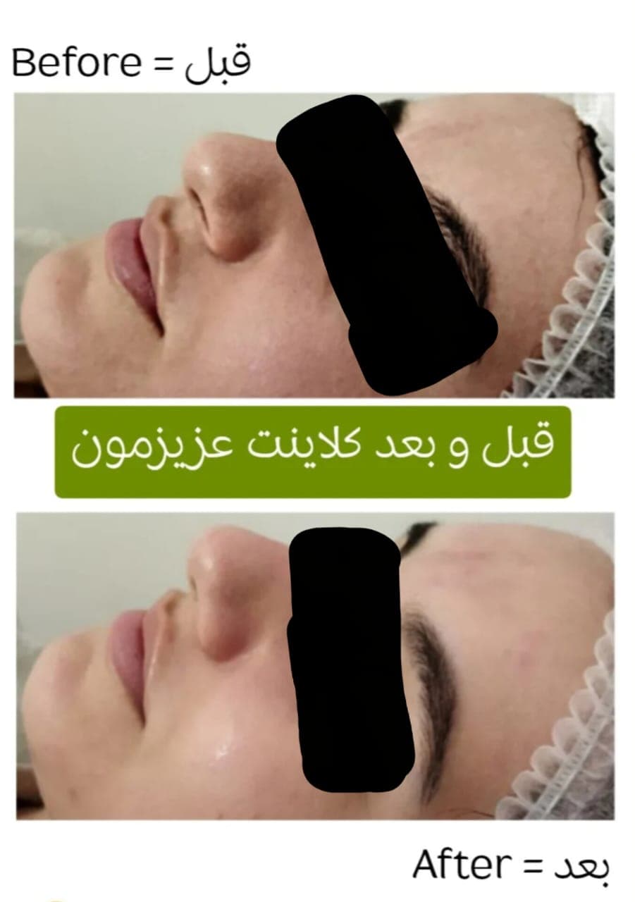 آموزش و درمان جوش و اسکار مرضیه سجادیان در کرمانشاه