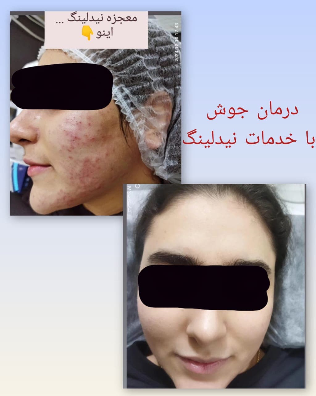 آموزش و درمان جوش و اسکار مرضیه سجادیان در کرمانشاه